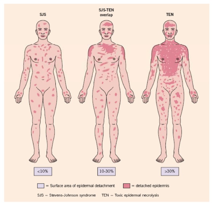 Steven Johnson Syndrome adalah Kelainan pada Kulit & Selaput Lendir ...